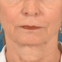 Lip Lift Before & After Gallery - Patient 218091 - Image 1