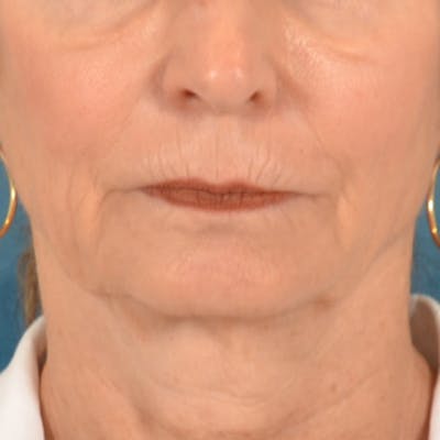 Lip Lift Before & After Gallery - Patient 218091 - Image 1