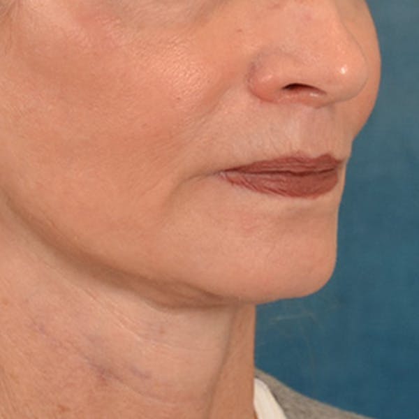 Lip Lift Before & After Gallery - Patient 218091 - Image 4