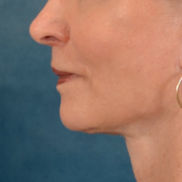 Lip Lift Before & After Gallery - Patient 218091 - Image 10