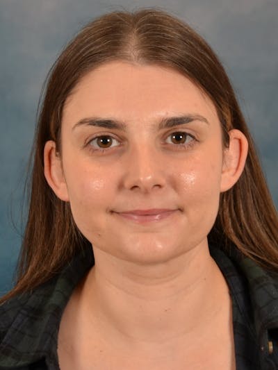 Deep Neck Lift Before & After Gallery - Patient 185172 - Image 2