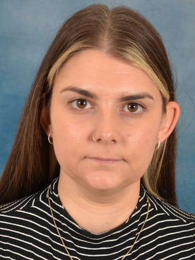 Deep Neck Lift Before & After Gallery - Patient 185172 - Image 1