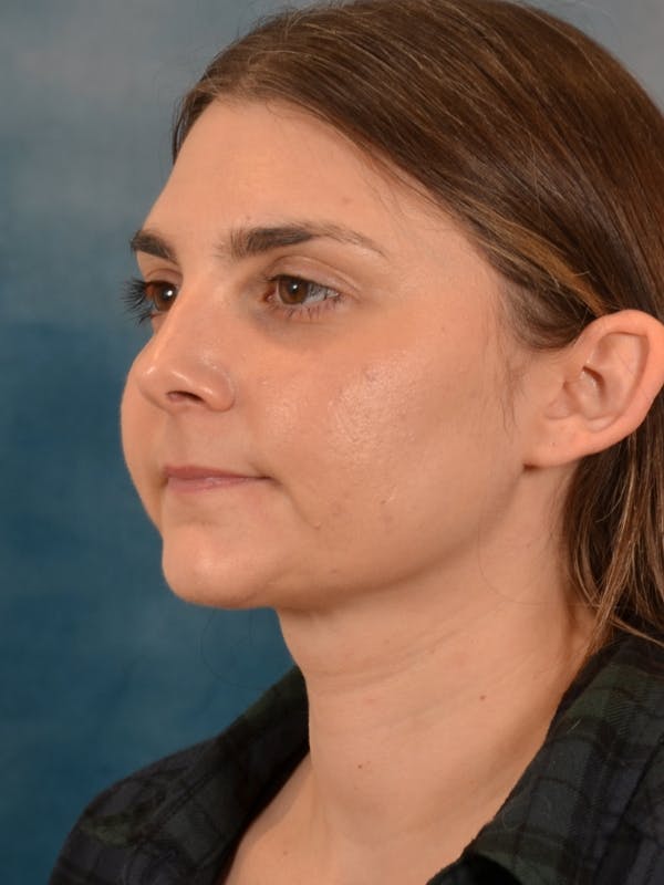 Deep Neck Lift Before & After Gallery - Patient 185172 - Image 4