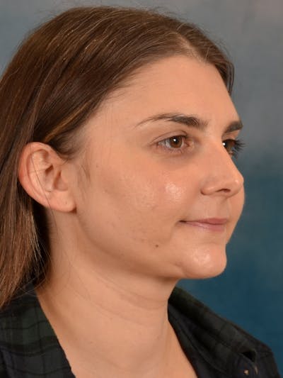 Deep Neck Lift Before & After Gallery - Patient 185172 - Image 8