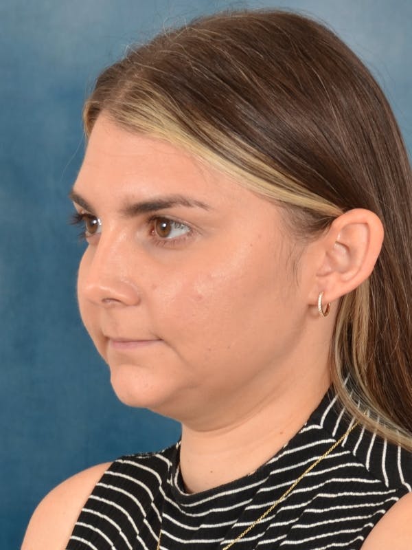 Deep Neck Lift Before & After Gallery - Patient 185172 - Image 3