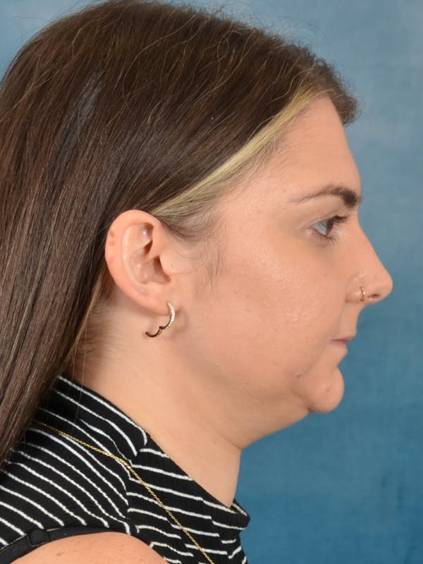 Deep Neck Lift Before & After Gallery - Patient 185172 - Image 9