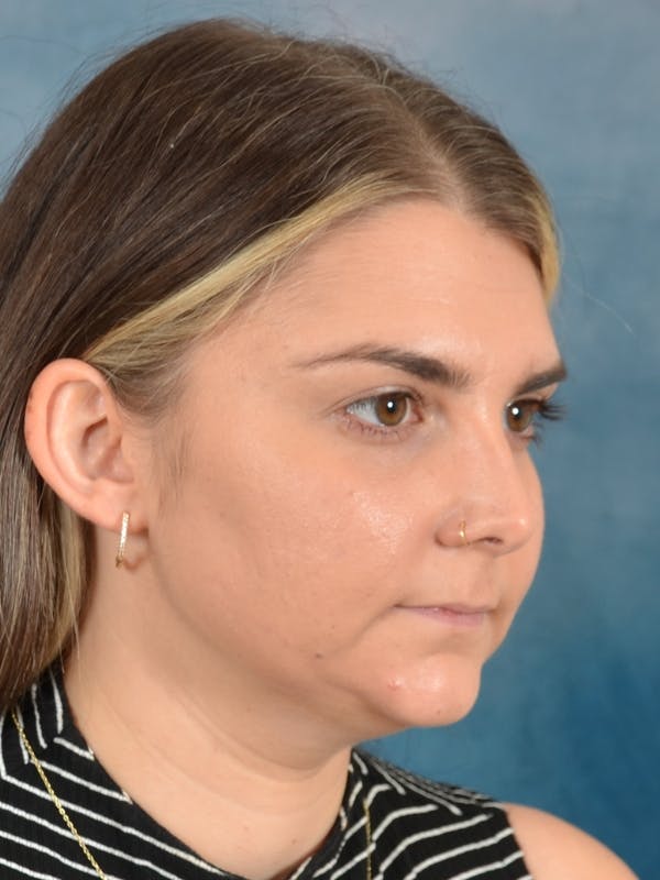 Deep Neck Lift Before & After Gallery - Patient 185172 - Image 7