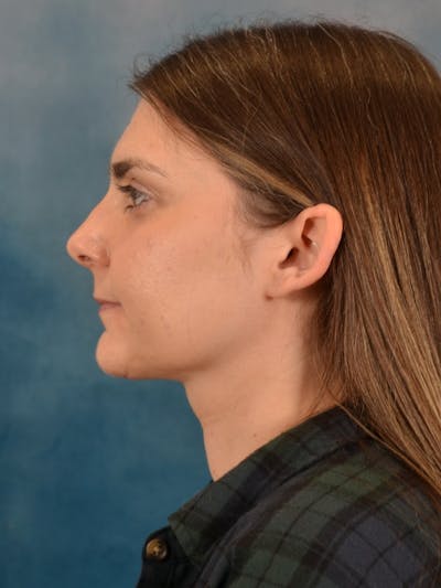 Deep Neck Lift Before & After Gallery - Patient 185172 - Image 6