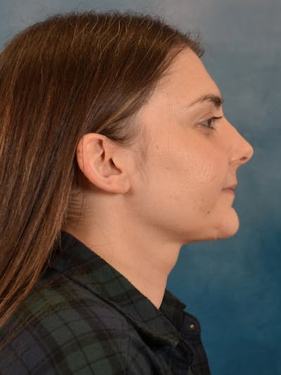 Deep Neck Lift Before & After Gallery - Patient 185172 - Image 10