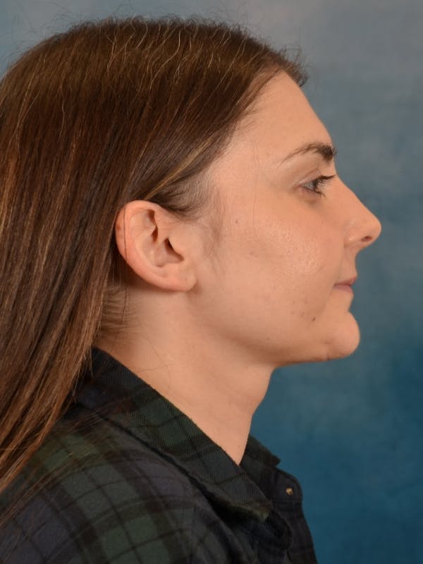 Deep Neck Lift Before & After Gallery - Patient 185172 - Image 10