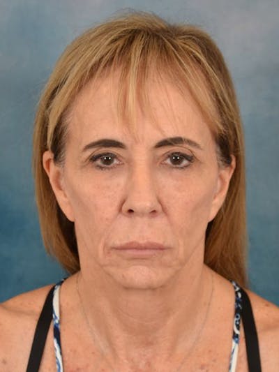 Fat Transfer Before & After Gallery - Patient 306237 - Image 1