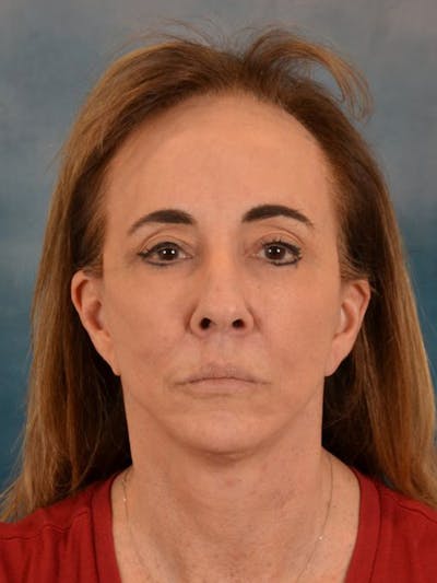 Fat Transfer Before & After Gallery - Patient 306237 - Image 2