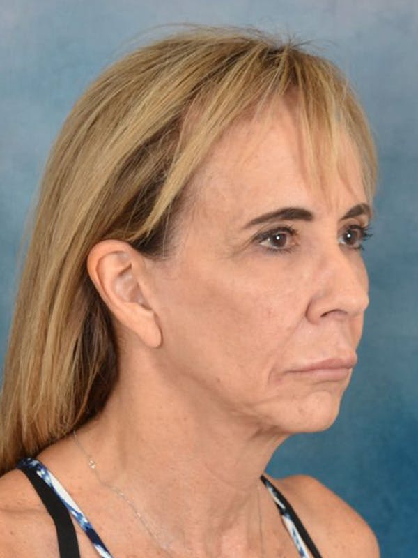 Brow Lift Before & After Gallery - Patient 222416 - Image 7