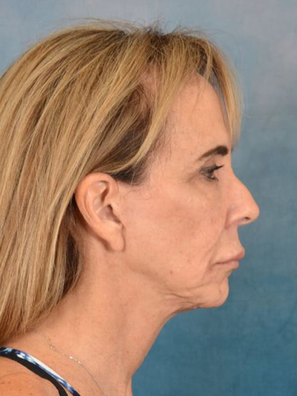 Brow Lift Before & After Gallery - Patient 222416 - Image 9