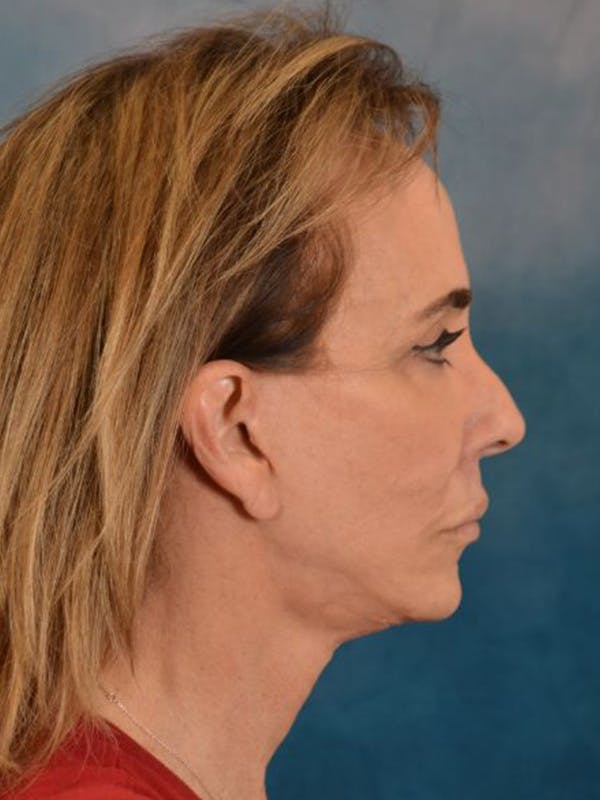 Brow Lift Before & After Gallery - Patient 222416 - Image 10