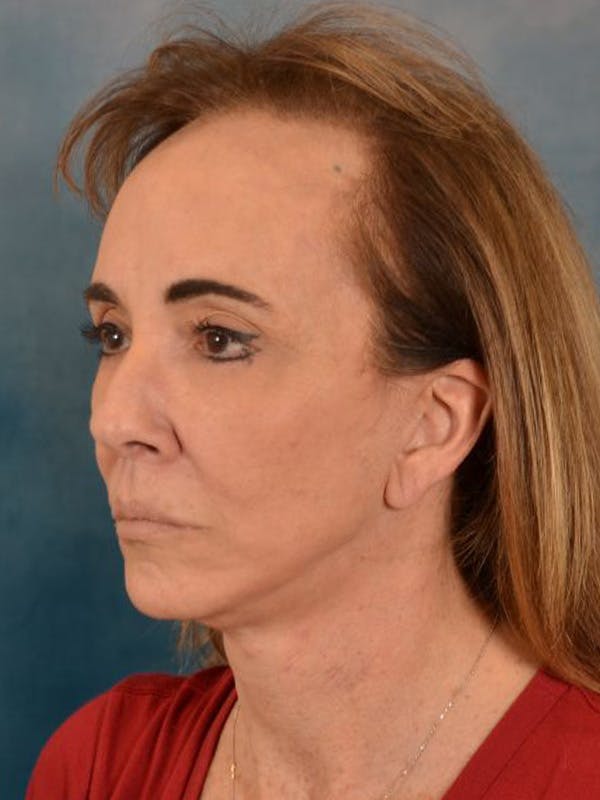 Brow Lift Before & After Gallery - Patient 222416 - Image 4