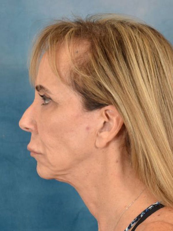 Brow Lift Before & After Gallery - Patient 222416 - Image 5
