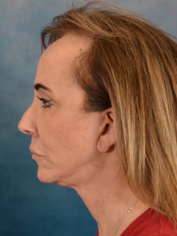 Brow Lift Before & After Gallery - Patient 222416 - Image 6