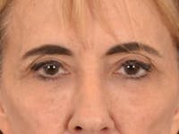 Eyelid Lift Before & After Gallery - Patient 402155 - Image 1