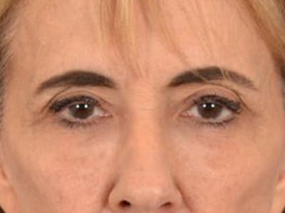 Eyelid Lift Before & After Gallery - Patient 402155 - Image 1