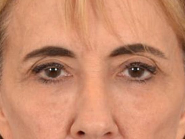 Eyelid Lift Before & After Gallery - Patient 402155 - Image 1