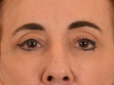 Eyelid Lift Before & After Gallery - Patient 402155 - Image 2