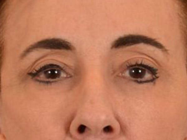 Eyelid Lift Before & After Gallery - Patient 402155 - Image 2