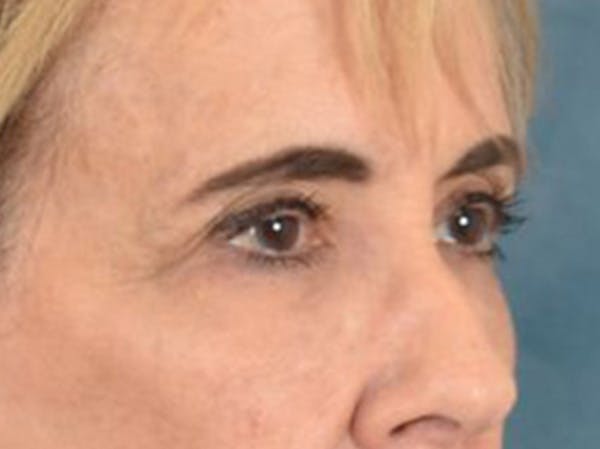 Eyelid Lift Before & After Gallery - Patient 402155 - Image 3