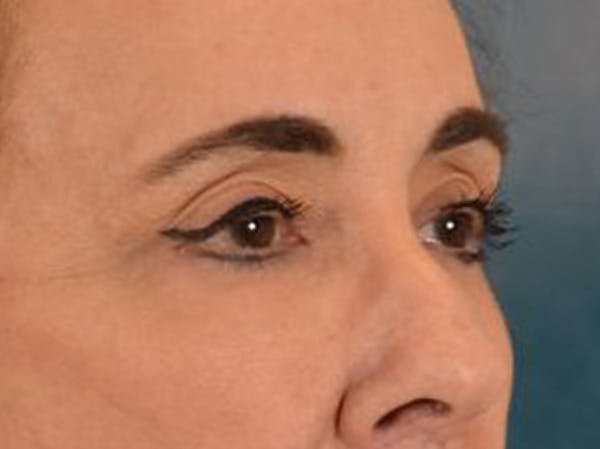 Eyelid Lift Before & After Gallery - Patient 402155 - Image 4