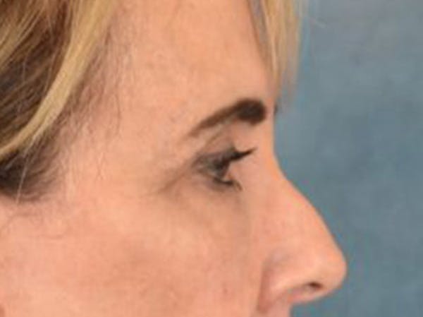 Eyelid Lift Before & After Gallery - Patient 402155 - Image 5