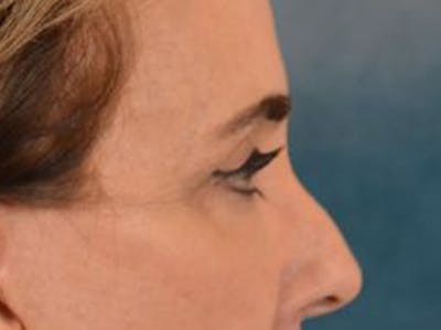 Eyelid Lift Before & After Gallery - Patient 402155 - Image 6