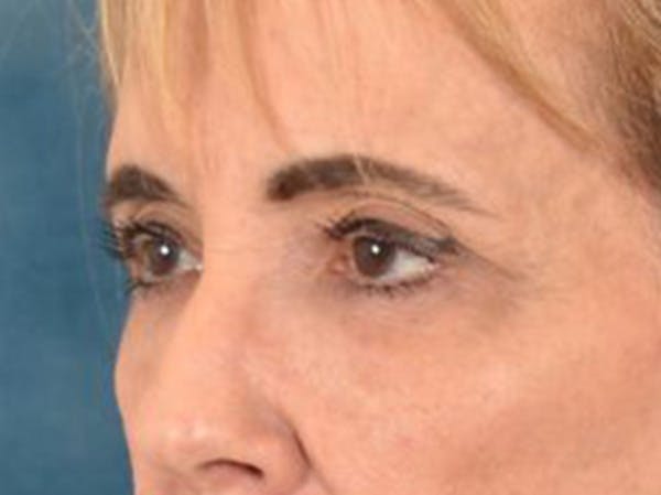 Eyelid Lift Before & After Gallery - Patient 402155 - Image 7