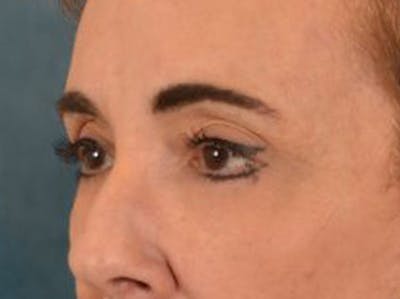 Eyelid Lift Before & After Gallery - Patient 402155 - Image 8