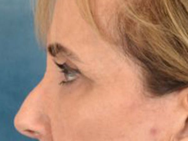Eyelid Lift Before & After Gallery - Patient 402155 - Image 9
