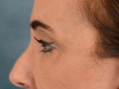 Eyelid Lift Before & After Gallery - Patient 402155 - Image 10