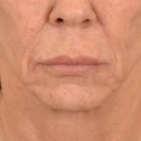 Lip Lift Before & After Gallery - Patient 108832 - Image 1