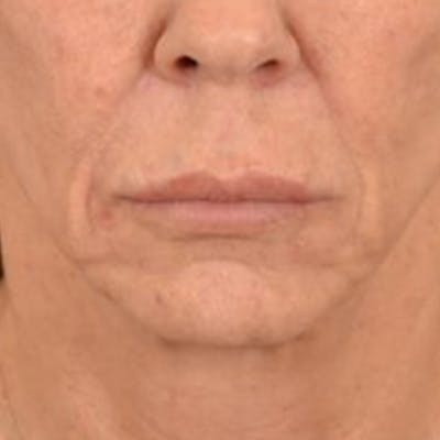 Lip Lift Before & After Gallery - Patient 108832 - Image 1
