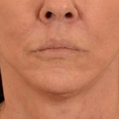 Lip Lift Before & After Gallery - Patient 108832 - Image 2