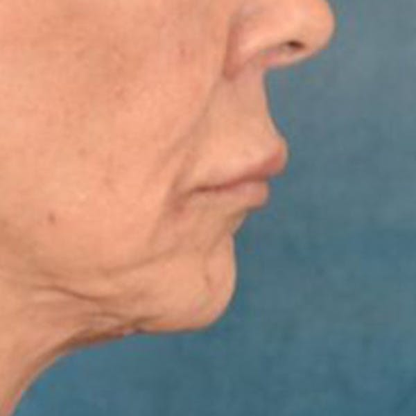 Lip Lift Before & After Gallery - Patient 108832 - Image 5