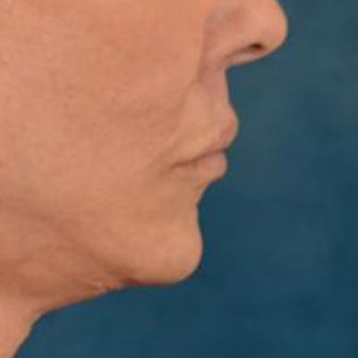 Lip Lift Before & After Gallery - Patient 108832 - Image 6