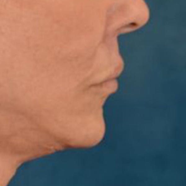 Lip Lift Before & After Gallery - Patient 108832 - Image 6