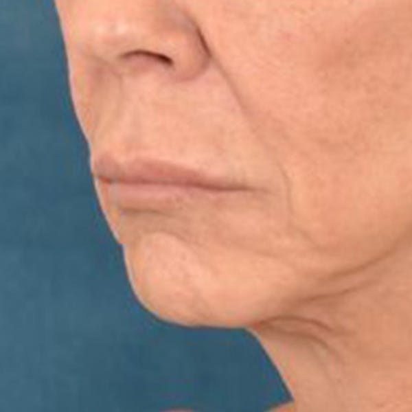 Lip Lift Before & After Gallery - Patient 108832 - Image 7