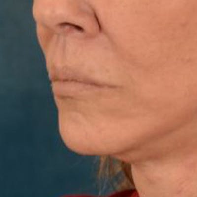 Lip Lift Before & After Gallery - Patient 108832 - Image 8
