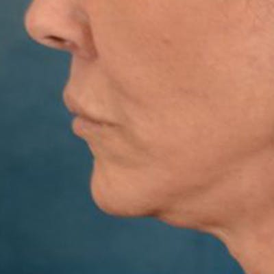 Lip Lift Before & After Gallery - Patient 108832 - Image 10