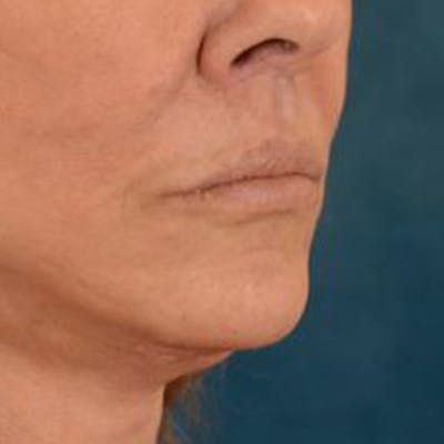 Lip Lift Before & After Gallery - Patient 108832 - Image 4