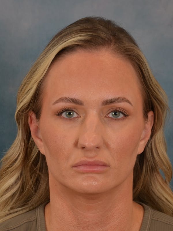 Rhinoplasty Before & After Gallery - Patient 407355 - Image 3
