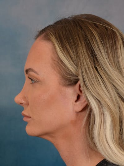 Rhinoplasty Before & After Gallery - Patient 407355 - Image 2