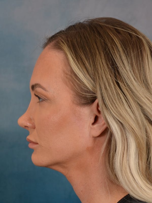 Rhinoplasty Before & After Gallery - Patient 407355 - Image 2