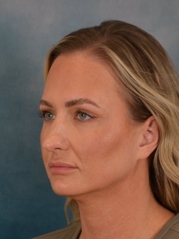 Rhinoplasty Before & After Gallery - Patient 407355 - Image 9