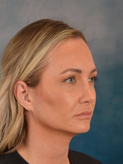 Rhinoplasty Before & After Gallery - Patient 407355 - Image 10